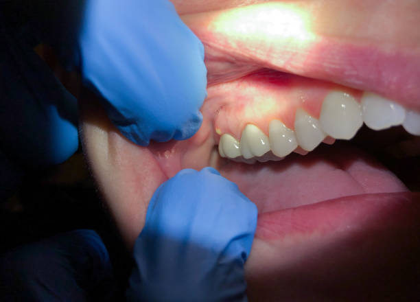 Best Emergency Dental Care for Broken or Chipped Teeth in Mather, CA